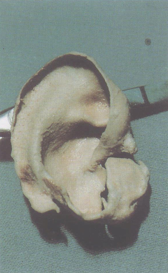 图1.4 耳廓的软骨架